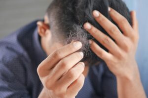 Causas e Tratamentos para Calvície Masculina