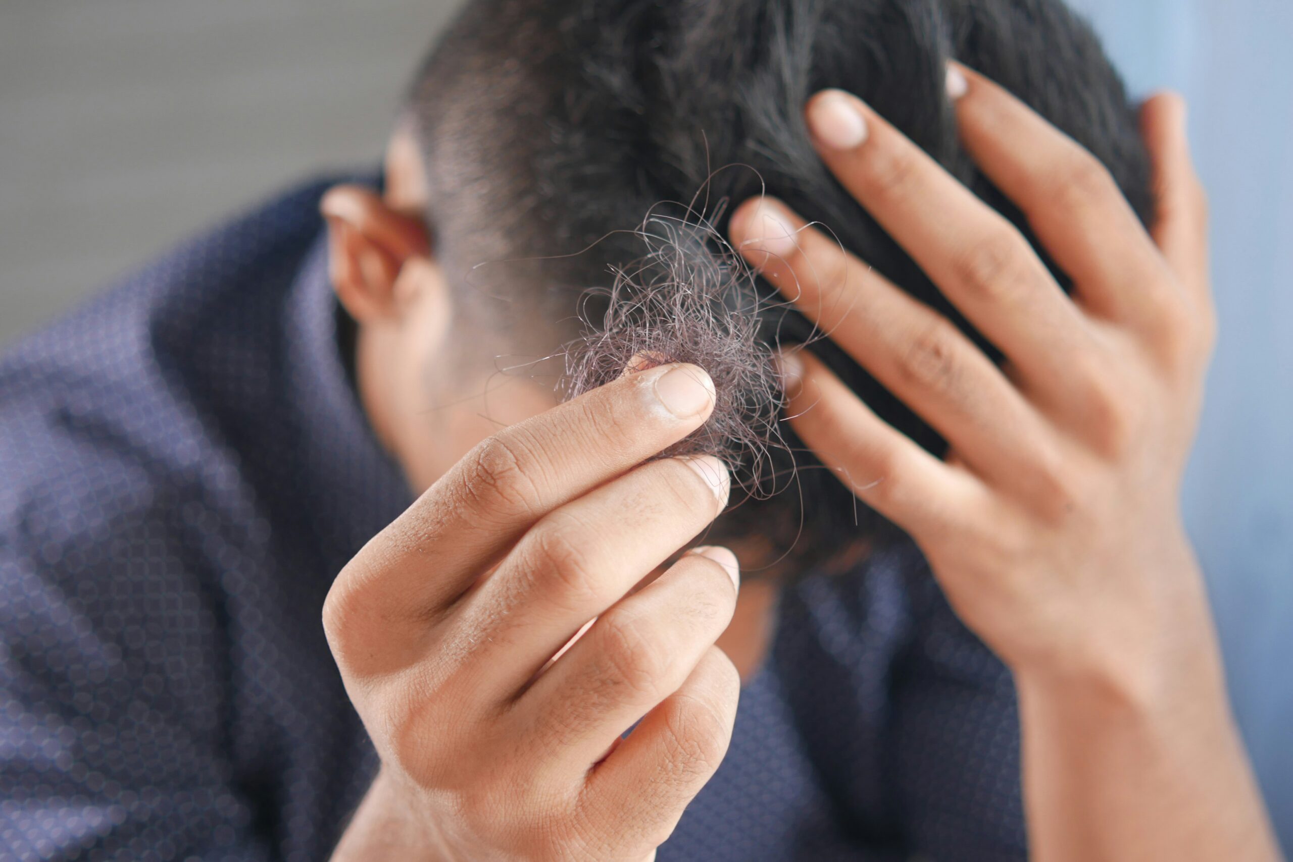 Causas e Tratamentos para Calvície Masculina